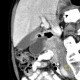 Enteric cyst of duodenum: CT - Computed tomography